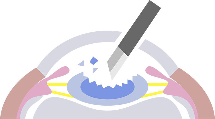 ③濁った水晶体を砕き吸い出します