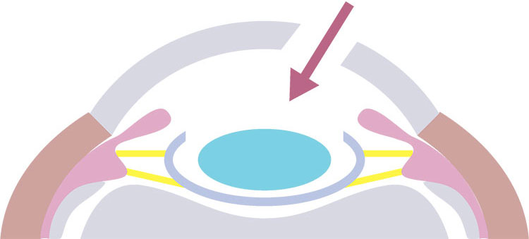 ④眼内レンズを挿入します